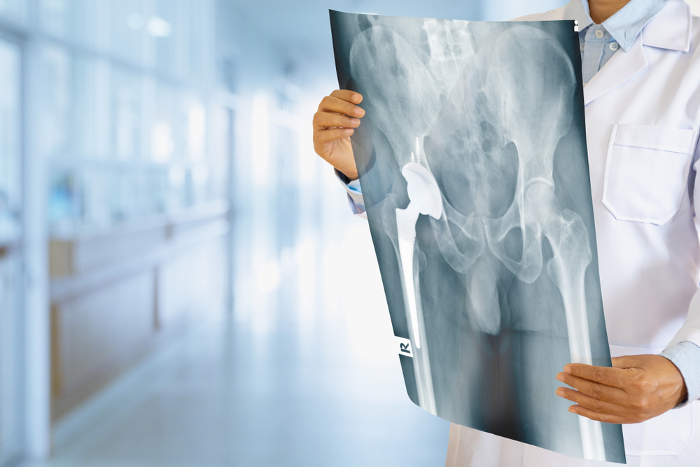 Hip Replacement Surgery